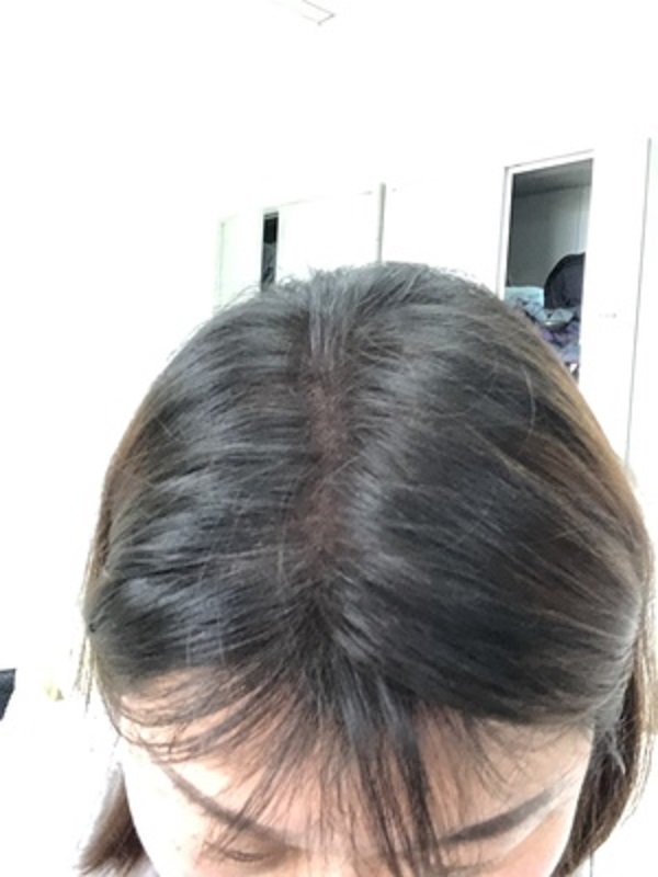 乐观派也架不住脱发的悲哀