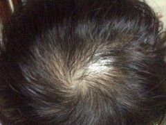 头发少的问题太烦人了