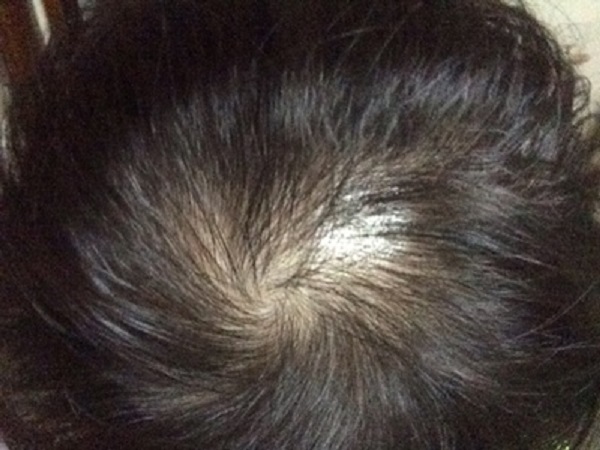 头发少的问题太烦人了