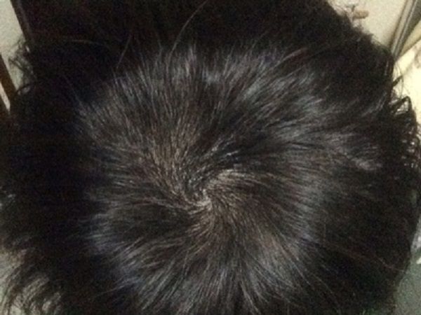 本该是较好的年纪却患上了脱发