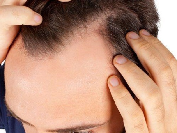 为什么有的人头发少可以植发，有的人却不可以？