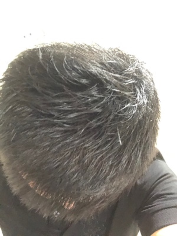 不理会脱发的后果