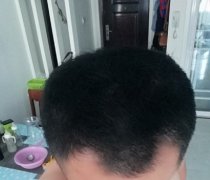 脱发带来的影响怎么消除