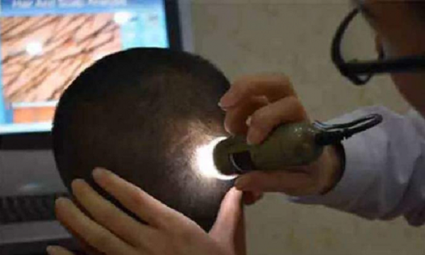 为什么要选择植发