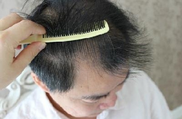 怎么预防治疗脂溢性脱发