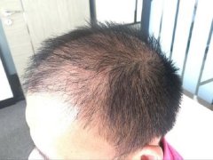 植发10天就能看出一年后的效果吗