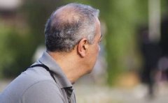 脱发是肾虚引起的吗