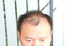 植发后的狂脱期到底是怎么回事