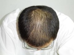 植发的副作用有多大