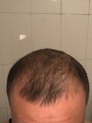 不好的生活习惯导致了我的脱发，谁来拯救我