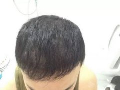 额头太高可以植发吗