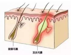 掉落的头发上会有毛囊吗