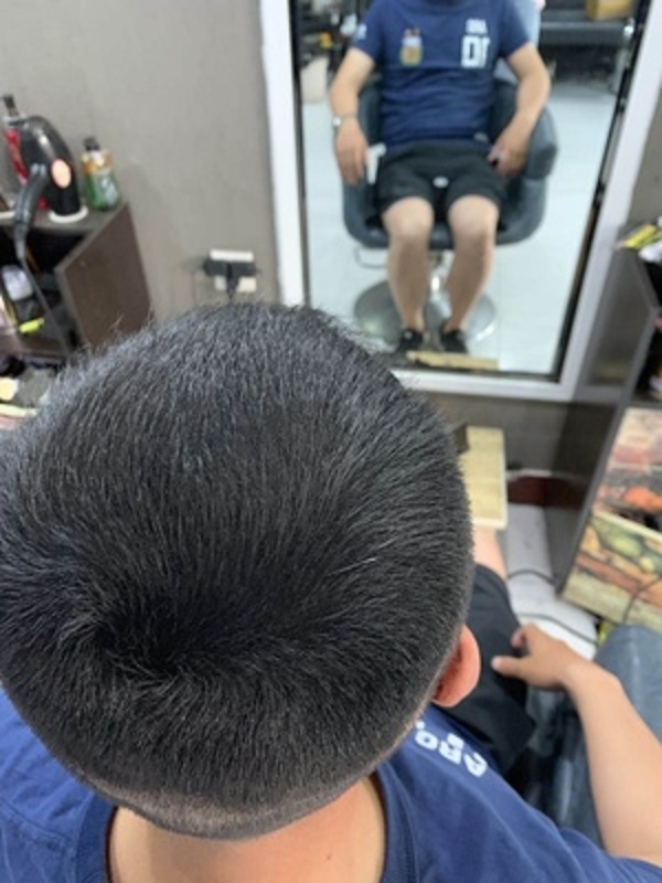 脱发到底应该怎么解决