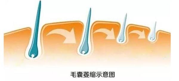 为什么植发一定要用自己的毛囊