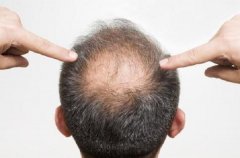 遗传性脱发最常发生于什么年龄段