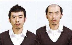 脱发初期应该要怎么治疗