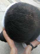 什么时候才能摆脱头发稀疏啊