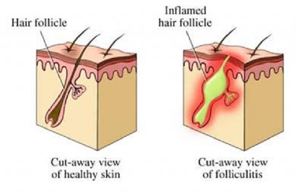 毛囊炎怎么根治