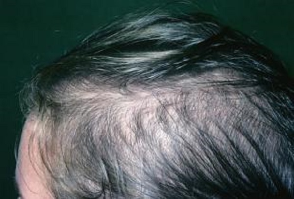 女性遗传性脱发还能够生发吗