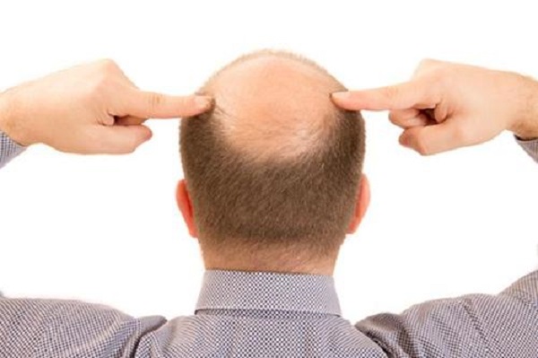 男性脱发一般是在什么年纪