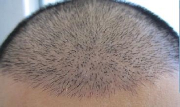 女性植发和男性植发的区别