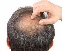 为什么脱发都是从头顶开始