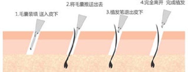 为什么植发要用后枕部的毛囊呢