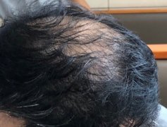 脱发所带来的问题应该要怎么解决