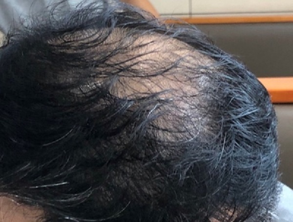 脱发所带来的问题应该要怎么解决