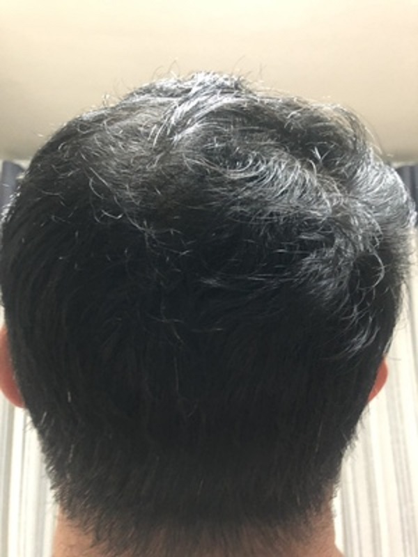 脱发所带来的问题应该要怎么解决