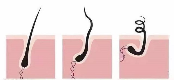 哪些方法可以判断脱发初期毛囊是否坏死