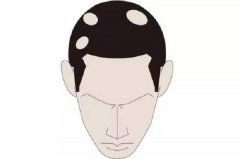 鬼剃头发生的原因是什么