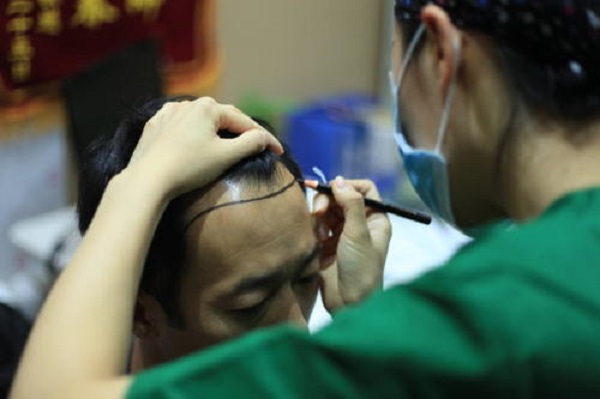 植发手术的成功率高不高