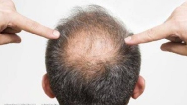 怎么样才能治好遗传性脱发