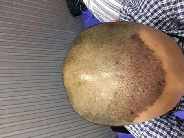 头上有疤还能植发吗