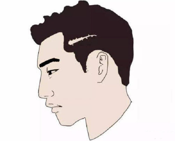 头上有疤还能植发吗