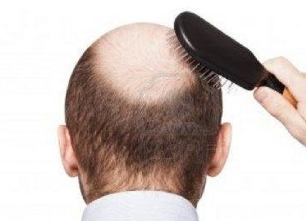 男性脱发的原因是什么