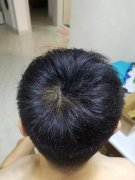 脱发的岁月里幸好让我遇见了增发纤维