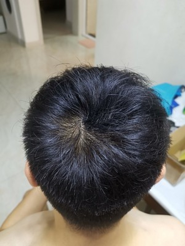 脱发的岁月里幸好让我遇见了增发纤维