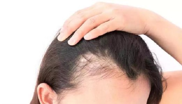 经常扎头发会导致发际线后移吗