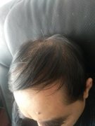 没想到我还能恢复形象，多亏了增发纤维