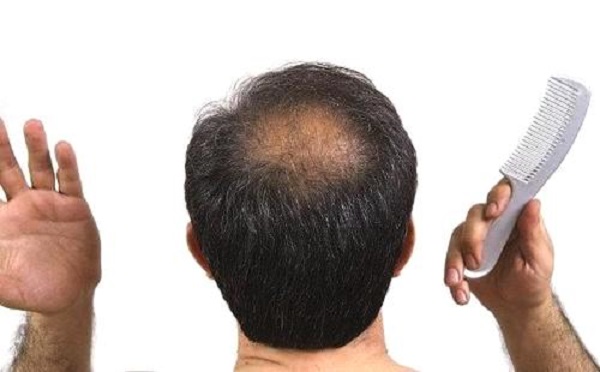 男性脱发有什么预兆吗