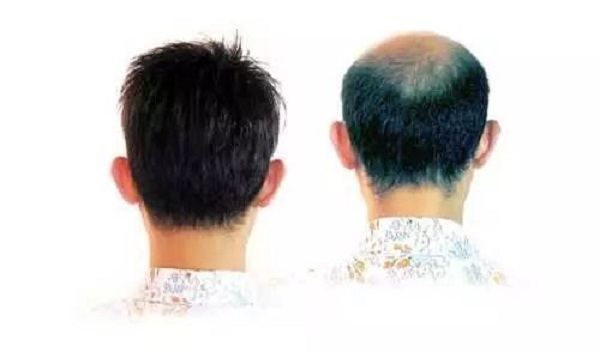 应该要怎么调理脂溢性脱发