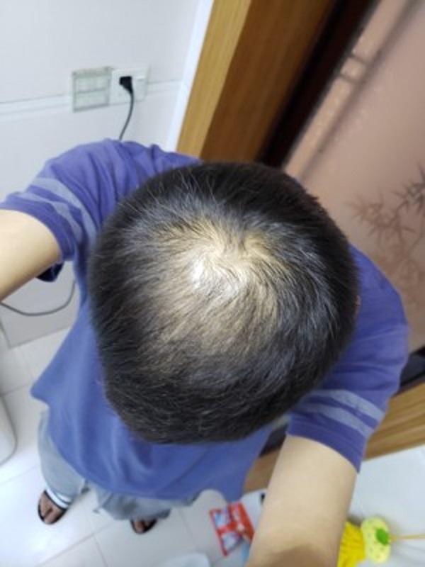 脱落的头发一去不返，但很幸运的是遇到了增发纤维