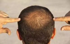 怎么分辨脱发是生理还是病理