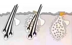 毛囊不长头发的原因是什么