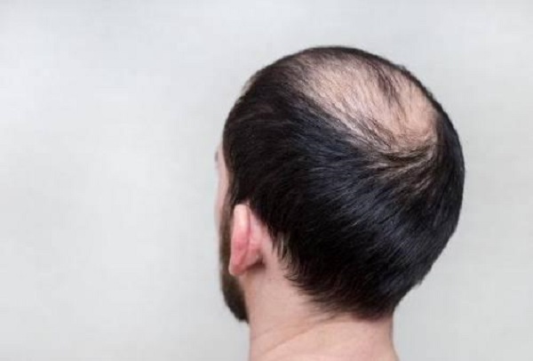 男性脱发能够治愈吗