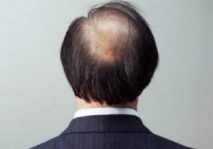 男性和女性脂溢性脱发的区别