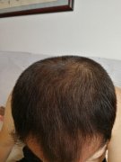 增发纤维拯救了脱发的我