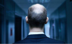 五种难治的脱发类型